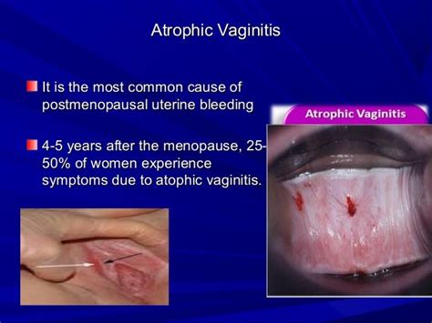 What does vulvar <b>atrophy</b> look like? Vulvar and vaginal mucosae may appear pale, shiny, and dry; if there is inflammation, they may appear reddened or pale with petechiae. . Clitoral atrophy symptoms